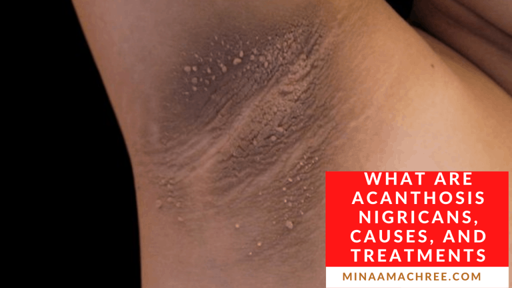 What Are Acanthosis Nigricans, Causes, And Treatments
